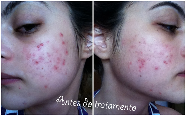 Como acabar com a acne – Acne.org