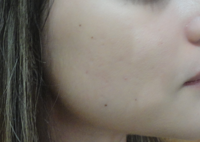 Pele sem acne - como acabar com a acne